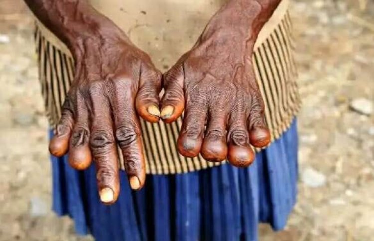 Papua New Guinea: Abagore bica intoki nk'ikimenyetso cy'agahinda ko gupfusha abagabo